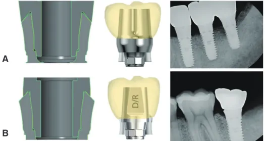 Fig. 10. (A) 2 CAD-CAM abutments of TL implant made by different laboratory. (B) Scanning electron micrographic image  of A abutment