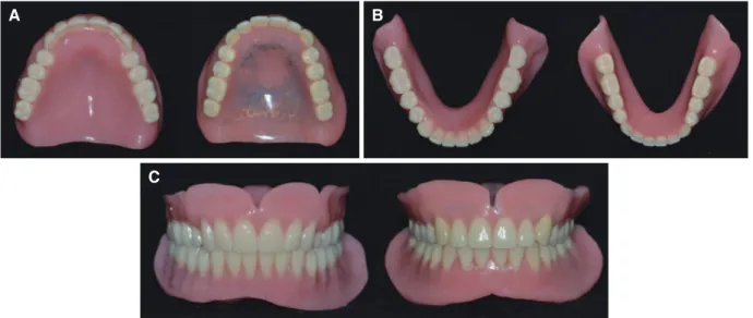Fig. 7. (A) Checking the occlusal plane of try-in denture at frontal view, (B) Checking the occlusal plane of try-in denture  at sagittal view, (C) Jaw relation recording on try-in denture and marking of midline.
