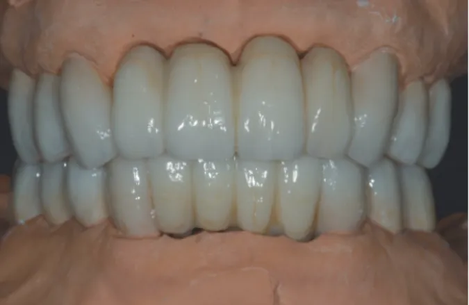 Fig. 5. Provisional restoration delivery.
