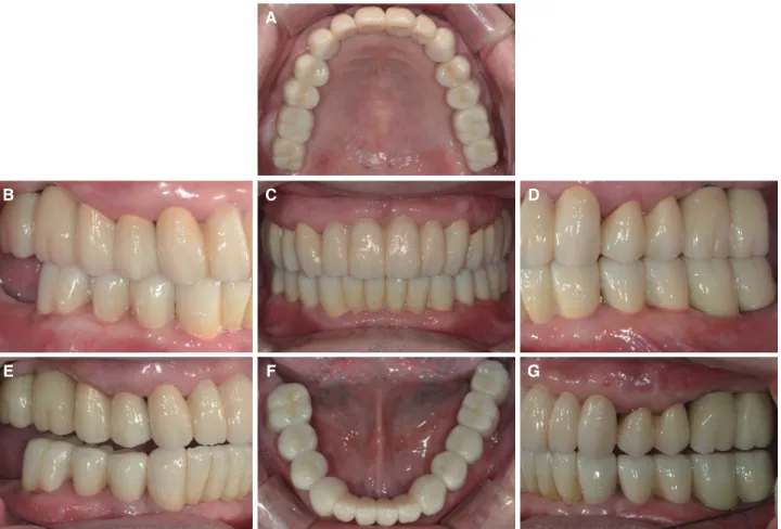 Fig. 7. Esthetics and function were restored with monolithic zirconia crown. (A) Maxillary occlusal view, (B) Right lateral  view, (C) Frontal view, (D) Left lateral view, (E) Right lateral movement view, (F) Mandibular occlusal view, (G) Left  lateral mov