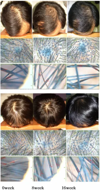 Fig. 5.  Clinical cases of alopecia patients before and after applying of herbal product containing Rosa multiflora roots extracts as a main component.