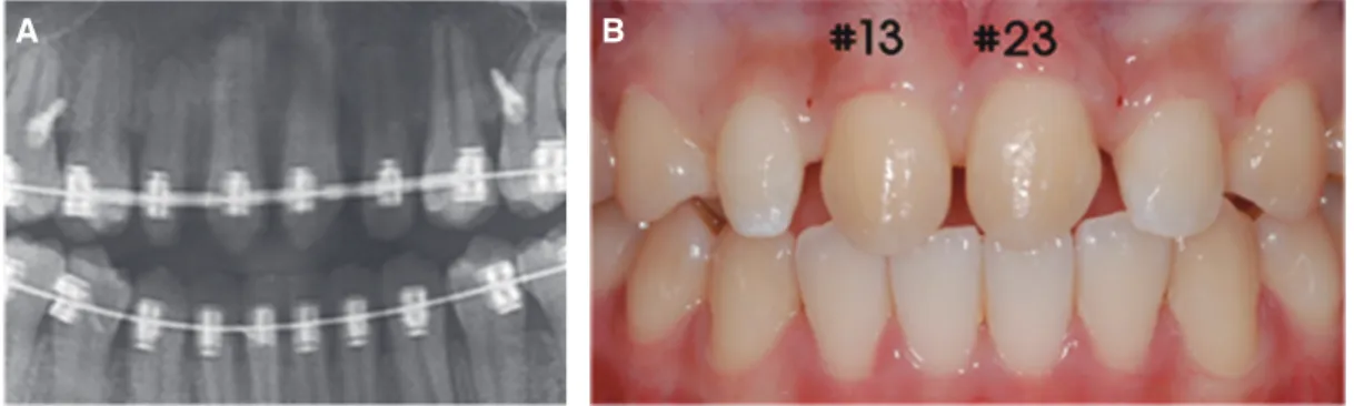 Fig. 8. After orthodontic treatment : #11, 21 teeth were extracted, #13, 23 teeth were moved to the #11, 21 teeth site  by orthodontic forced eruption