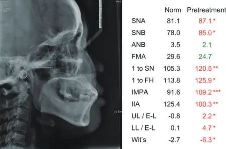 Fig. 3. Pretreatment cephalometric radiograph and analysis. * , ** , ***, indicates that the value is beyond one, two or  three times of the standard deviation.