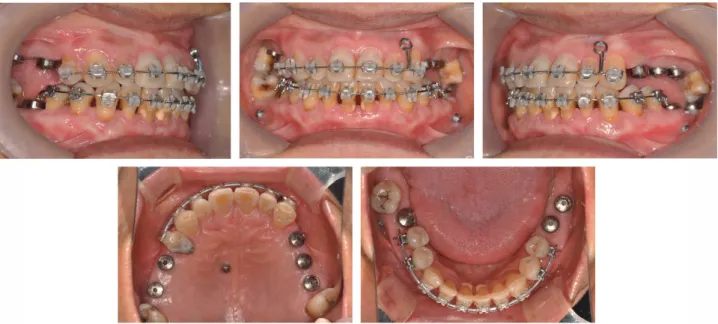 Fig. 7. Intraoral photos at 9 month, mini-screw was  implanted on palate. 가능하도록 함으로써 하악이 관절 내 정상적인 위치로 재위치 되도록 유도하는 것이 향후 최종 보철물의 교합 안정에 매우 중요하다