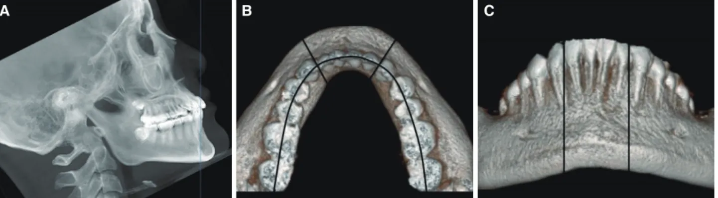 Fig. 2. Measurement of the alveolar bone thickness  (mm) and dimension (mm 2 ) on the sagittal section