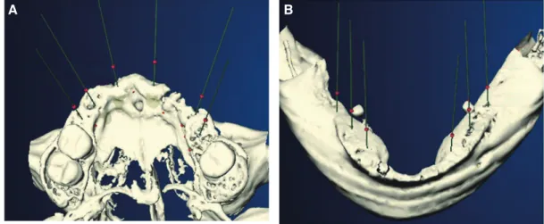 Fig. 3. 3-dimensional CT images. (A) Maxilla, (B) Mandible. 