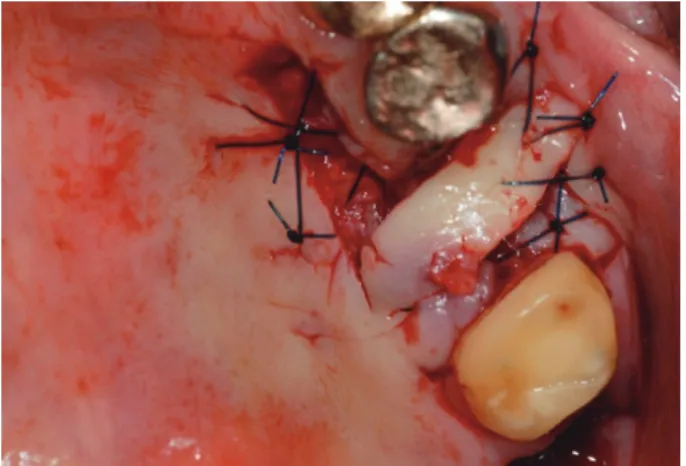 Fig. 3. The grafted site was covered with a rotated  palatal flap.