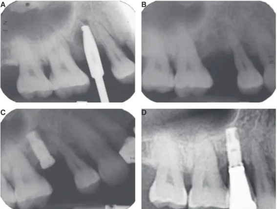 Fig. 1. Radiographs of upper right second premolar region. (A) At first trial for implant installation