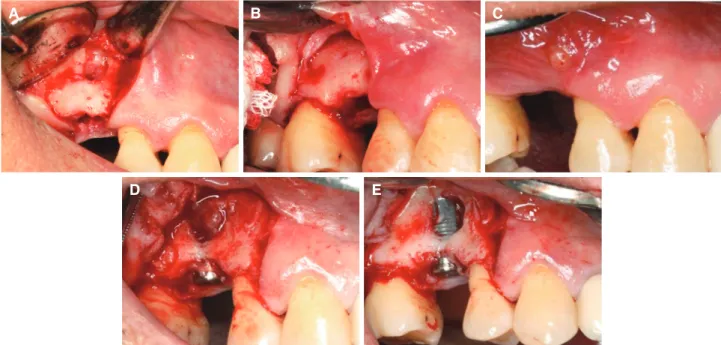 Fig. 2. Clinical view of upper right second premolar region. (A) At first trial for implant installation