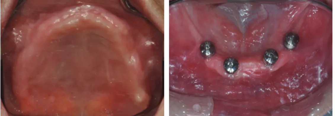 Fig. 1. Intraoral views after implant placement.