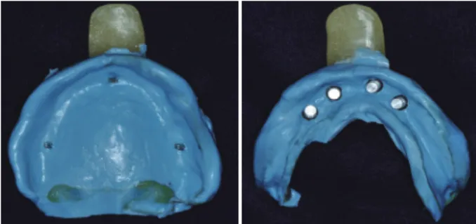 Fig. 4. Making the mandibular diagnostic model with  seating locator Ⓡ attachment analog and locator Ⓡ impression coping.