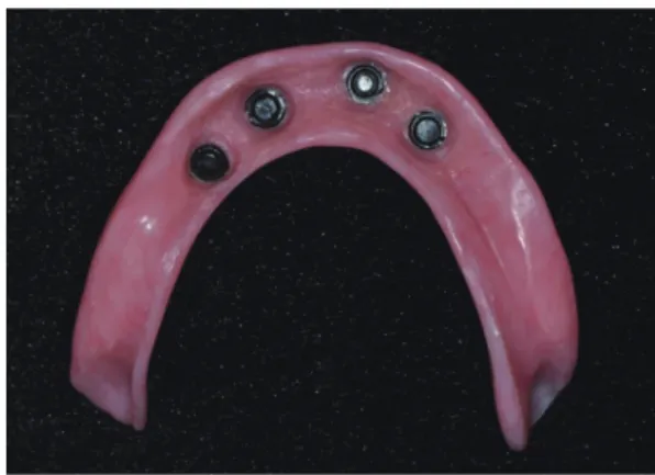 Fig. 13. Intraoral views with final dentures.