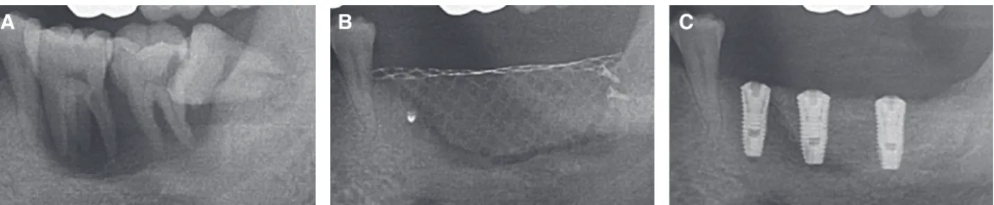Fig. 1. Radiograph on #35, 36, 37. (A) Before treatment, (B) Bone graft with titanium mesh, (C) After first implant surgery.