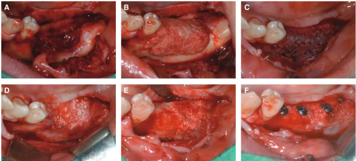 Fig. 2. Clinical picture of surgery. (A) Full thickness flap elevation, (B) First onlay bone graft with Tisseel Ⓡ  (Puros Ⓡ  1.5 cc,  Bio-oss Ⓡ  1.75 cc) &amp; titanium mesh application, (C) Full thickness flap elevation after 10 month later about first bo