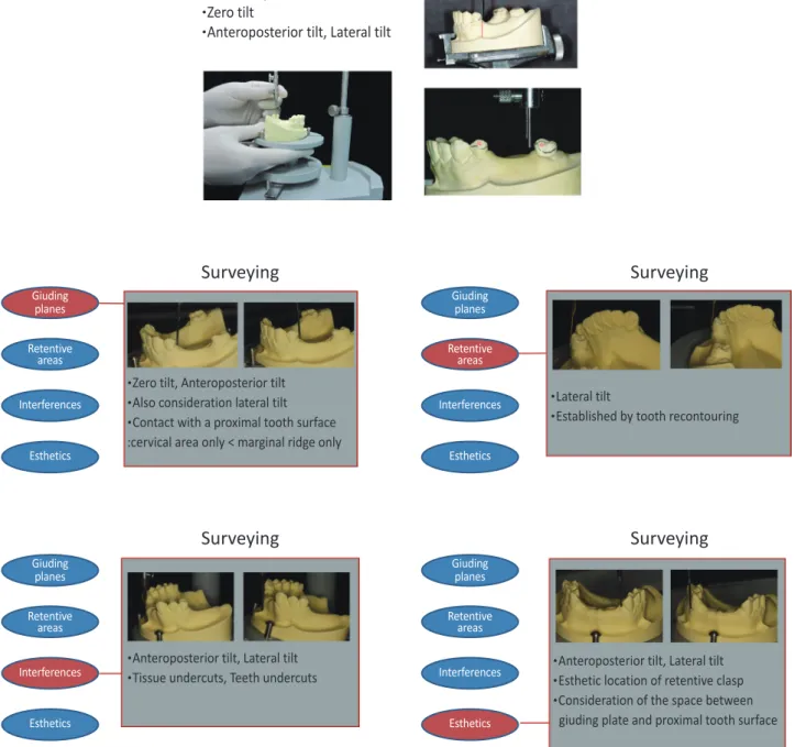 Fig. 4. Surveying of diagnostic cast.