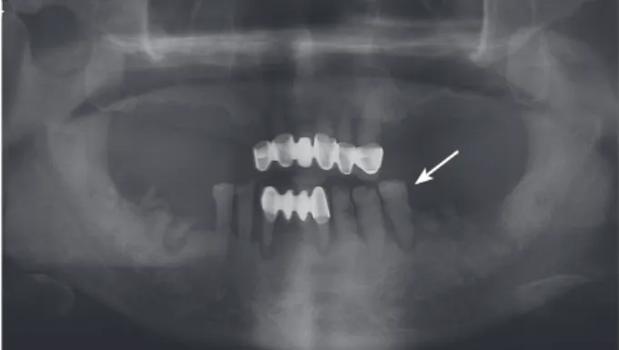 Fig. 8. Tooth supported partial denture can be designed  due to the presence of healthy third molars.