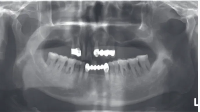 Fig. 1. Residual dentition and bone loss due to advanced  periodontal disease.