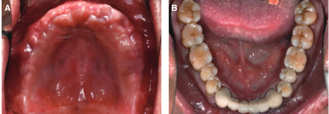 Fig. 3. Implant placement in maxilla for conventional  loading.