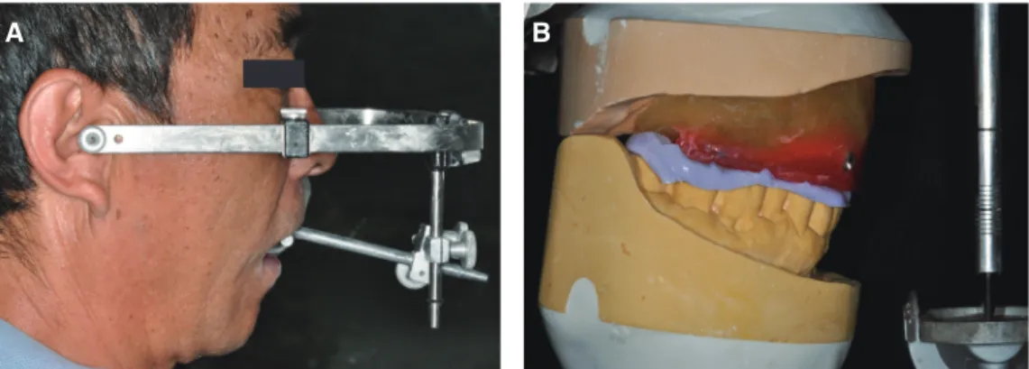 Fig. 7. Diagnostic wax coping try-in for determination of standard esthetic parameters