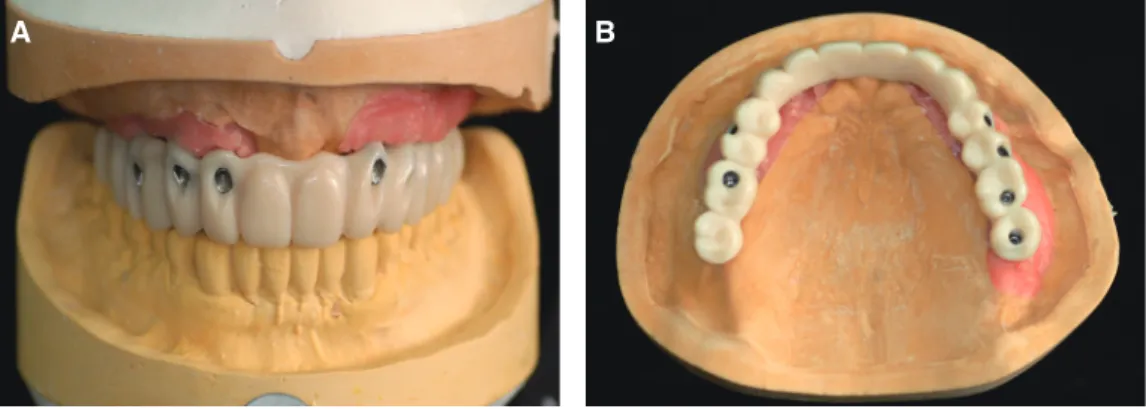 Fig. 9. Try-in of prostheses to customized titanium abutment. (A) Frontal view, (B) Occlusal view.
