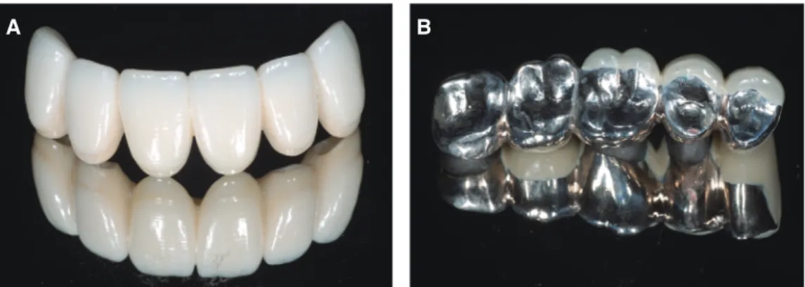 Fig. 10. Final prostheses to Pd-Ag Alloy and zirconia after being veneered. (A) Zirconia, (B) Pd- Pd-Ag alloy.