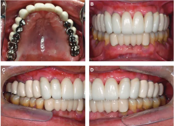 Fig. 11. Esthetics and fuction were restored with the Pd-Ag alloy and zirconia restorations