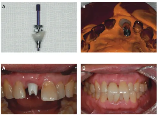 Fig. 20. Final restoration. (A)  Connection of customized  zirconia abutment, (B) Final  restoration setting.