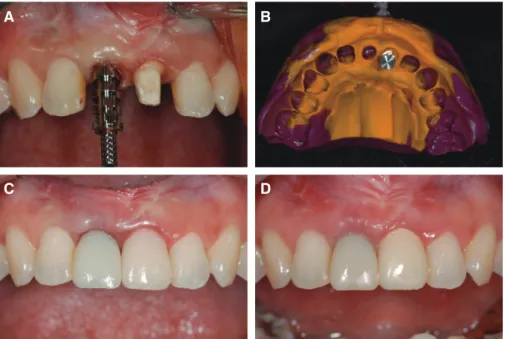Fig. 4. Customized impression coping and final impression. (A) Placement of the  provisional restoration connected with the analog into the putty container, (B)  impression with customized impression coping for final restoration.