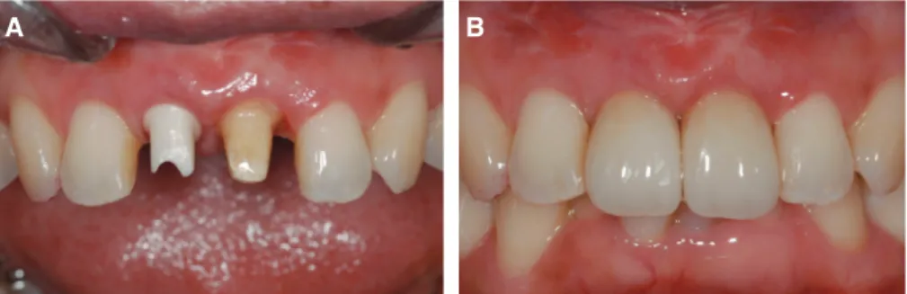 Fig. 5. Final restoration. (A) Connection of customized zirconia abutment, (B) Final  restoration setting.