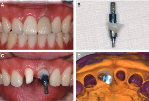 Fig. 9. Final impression taking. (A) 16 weeks after implant installation and implant  provisional restoration setting, (B) Customized impression coping, (C) connection of  customized impression coping, (D) impression with customized impression coping  for 