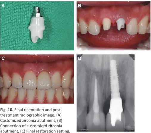 Fig. 10. Final restoration and post- post-treatment radiographic image. (A)  Customized zirconia abutment, (B)  Connection of customized zirconia  abutment, (C) Final restoration setting,  (D) Periapical standard radiographic  image.