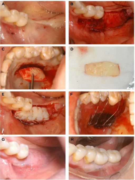 Fig. 1. Free gingival graft for the increase of keratinized tissue. A. Atrophic alveolar ridge and narrow keratinized tissue on the left mandibular molar site (#36,37)