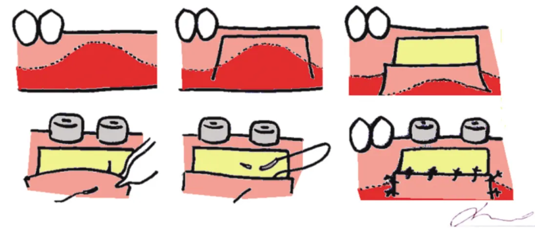 Fig. 2. Apically postioned flap. Bilateral vertical incisions were made mesial and distal to the selected surgical area and apically beyond the mucogingival junction