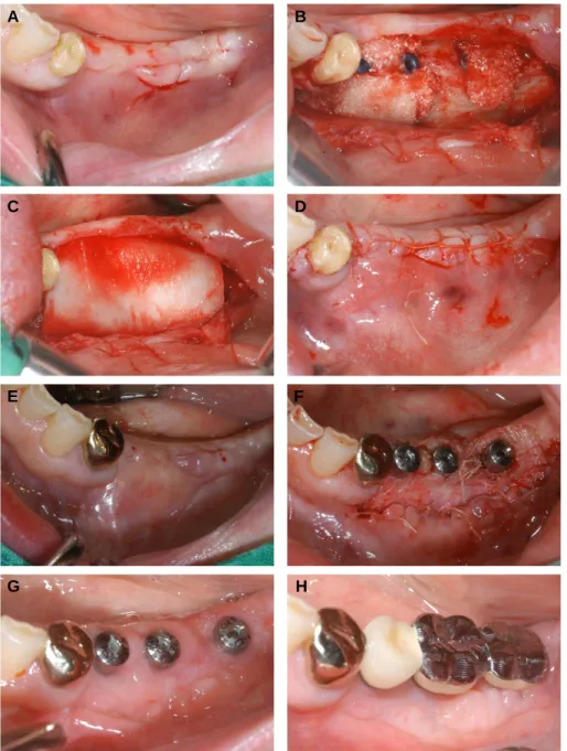 Fig. 3. Case 1. A. Presurgical state after healing of #37 simple extraction window. B