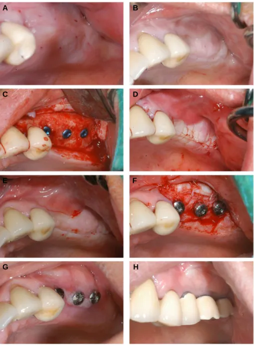 Fig. 4. Case 2. A. Presurgical state after healing of #25 simple extraction window. B
