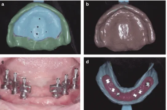 Fig. 3. Impression of maxillary edentulous arch using individualized tray and polysulfide rubber impression material (a, b)
