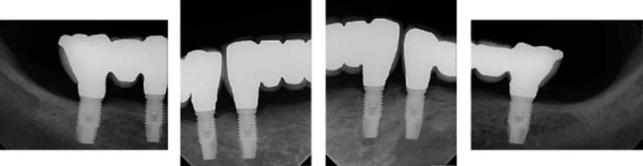Fig. 7. Periapical view of the screw-retained fixed restoration.