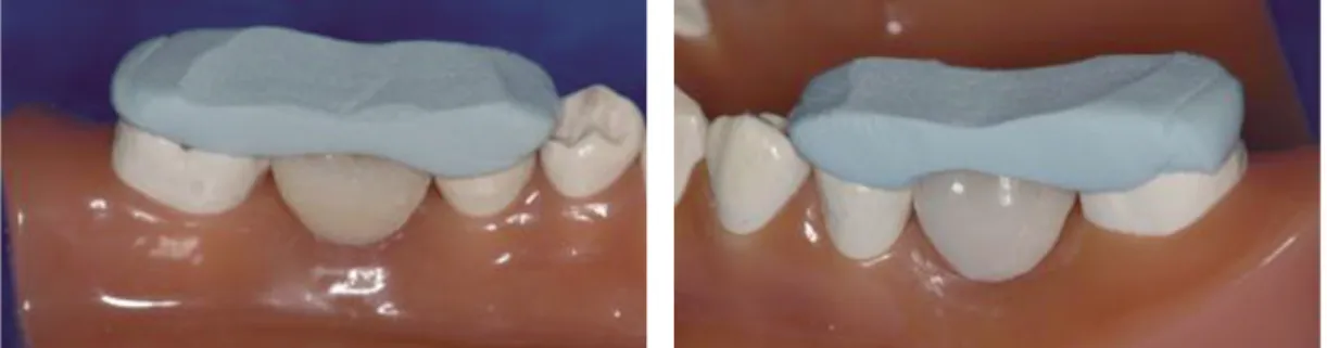 Fig. 4. 5 - 6 mm line connection in lingual surface of molar tooth.