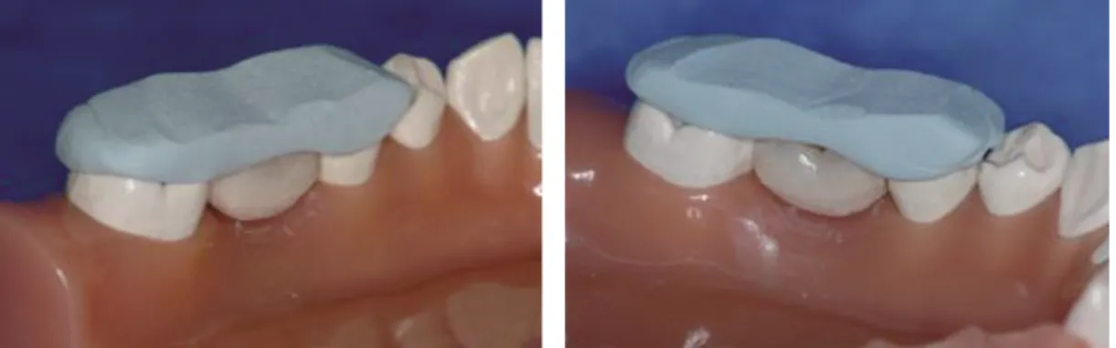 Fig. 8. Fix the adjusted pontic with putty index.