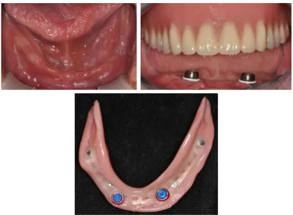 Fig. 1. Locator attachments were used in severely resorbed mandible. The location of implants were not ideal