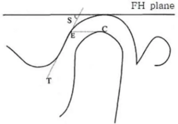 Fig. 4. Three tomographic sections perpendi- perpendi-cular to long axis of the condyle were chosen to represent lateral, central, and medial parts of the TMJ.