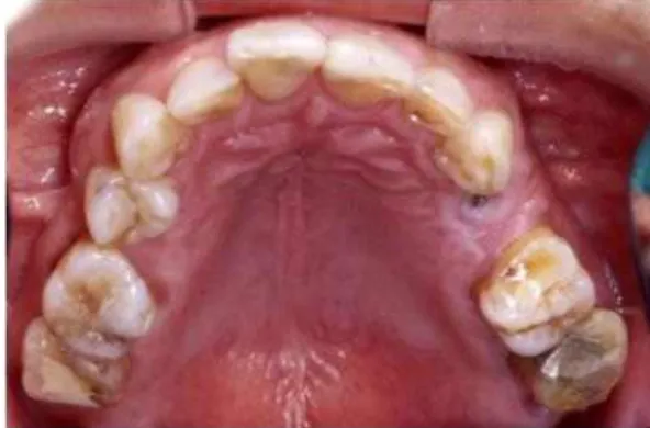 Fig. 1. A cover screw was partially exposed at the tooth missing area.