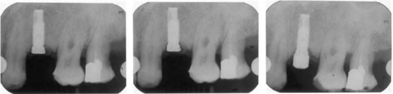 Fig. 2. Periapical radiographs. Marginal bone loss was perceived between installation time (top) and 2 month recall time (middle)