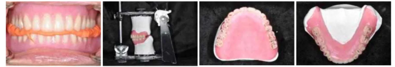 Fig. 12. Clinical remounting and occlusal adjustment. <Rt. eccentric movement at working side> <Rt
