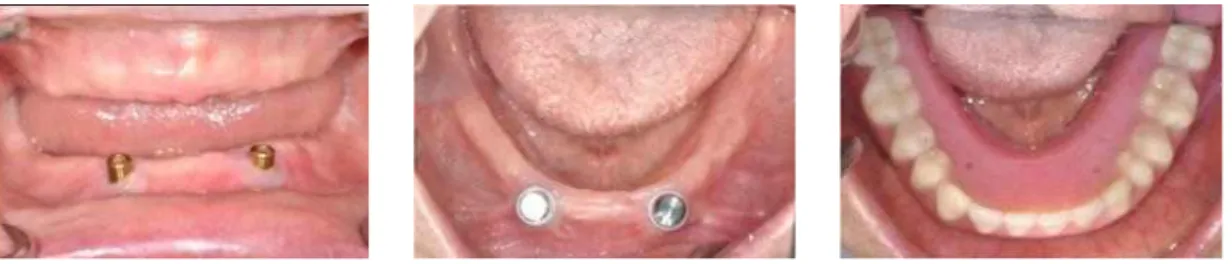 Fig. 14. Locator ® attachment. 시적하여 수직고경, 교합평면, 수평․수직 피개 량, 안모의 심미성 등을 평가하였으며, 최종적으 로 환자로 하여금 확인하도록 하였다