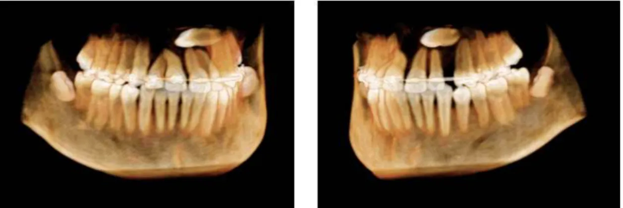 Fig. 8. CBCT Volume Rendering Images for #23 impacted tooth (18 months after treatment started).
