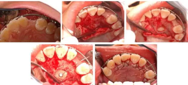 Fig. 10. Closed eruption technique for #23 erution (21 months after treatment started).
