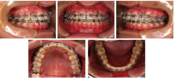 Fig. 12. Intra-oral photos during finishing stage (41 months after treatment started) 되었고, 정상적인 교합관계를 이루고 있다 (Fig