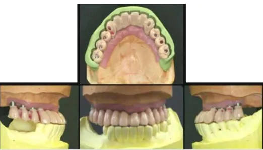 Fig. 31. Cut-back: check for porcelain space using PVS index.