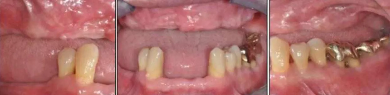 Fig. 6. Temporary partial denture